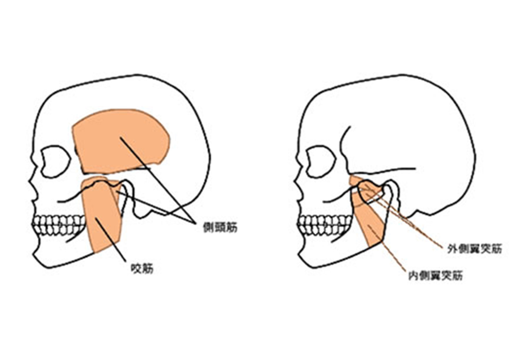 顎関節症