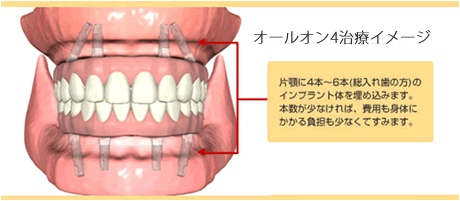 自由ヶ丘デンタルスタジオのインプラント