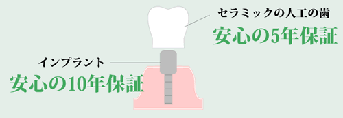 インプラントの料金