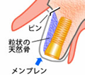 自由ヶ丘デンタルスタジオのインプラント