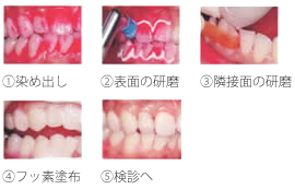 クリーニングの治療費