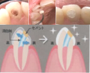 自由ヶ丘デンタルスタジオのホワイトニング